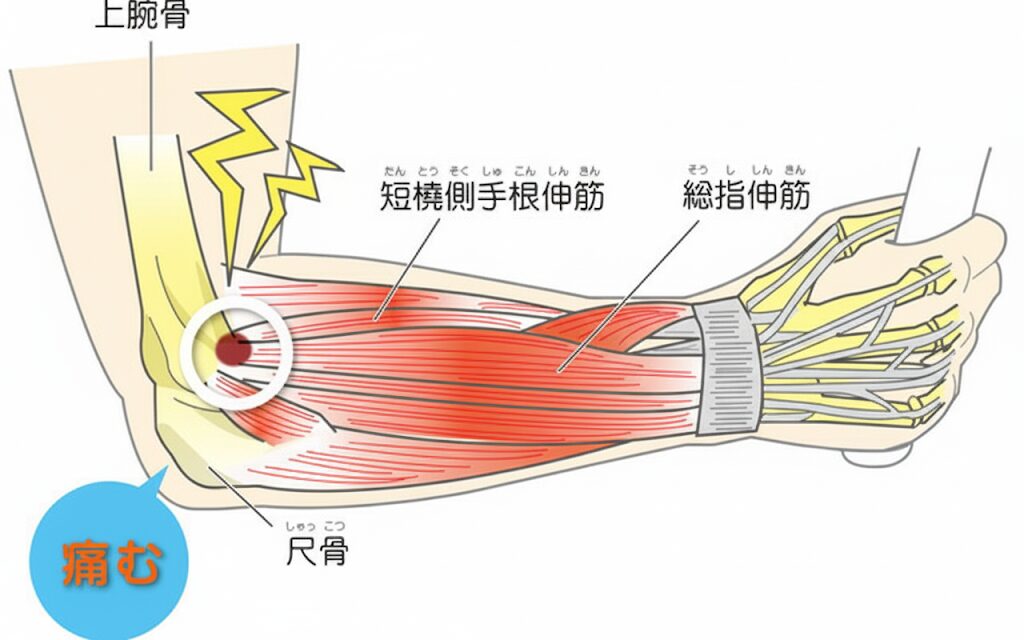 テニス肘(上腕骨外側上顆炎)