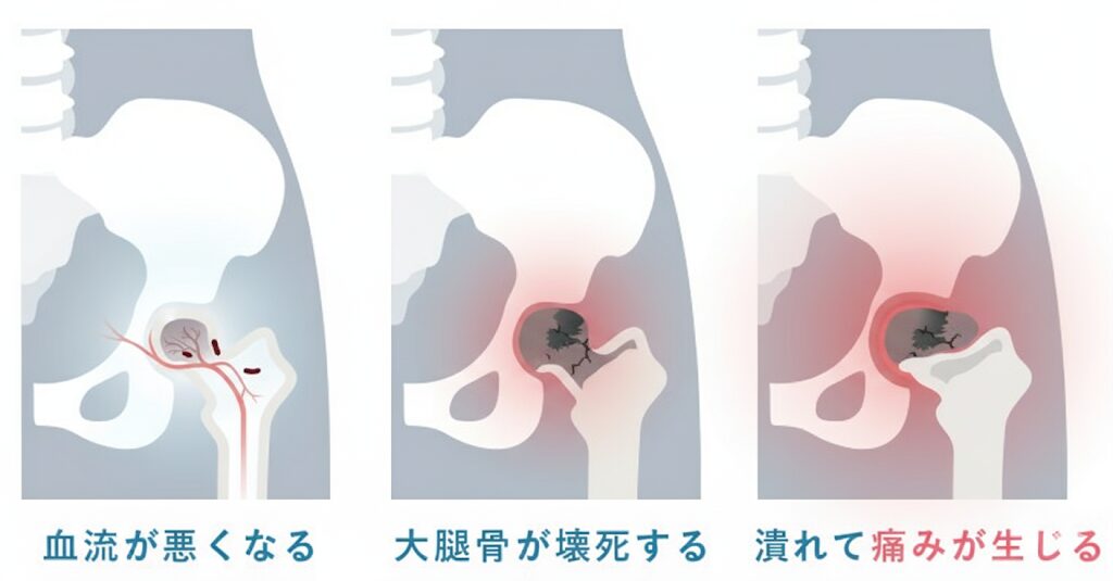 特発性大腿骨頭壊死症とはどんな病気